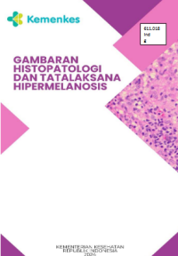 Gambaran Histopatologi dan Tatalaksana Hipermelanosis